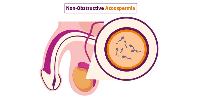 Understanding Nonobstructive Azoospermia: Causes and Solutions