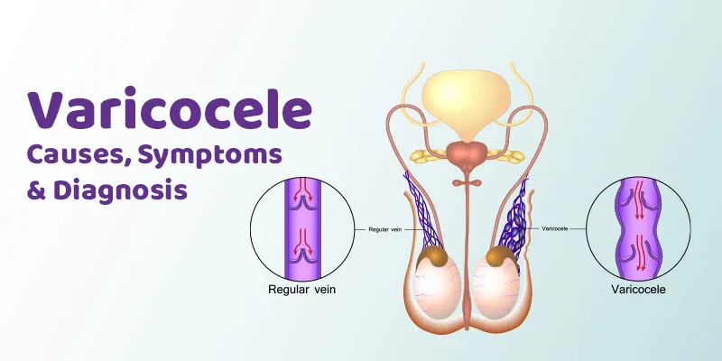 Varicocele — Causes, Symptoms & Diagnosis