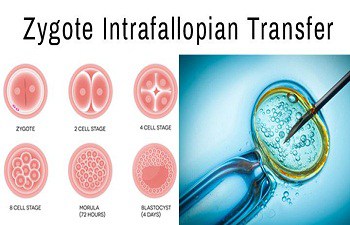 Zygote Intrafallopian Transfer (ZIFT) for Blocked Fallopian Tubes