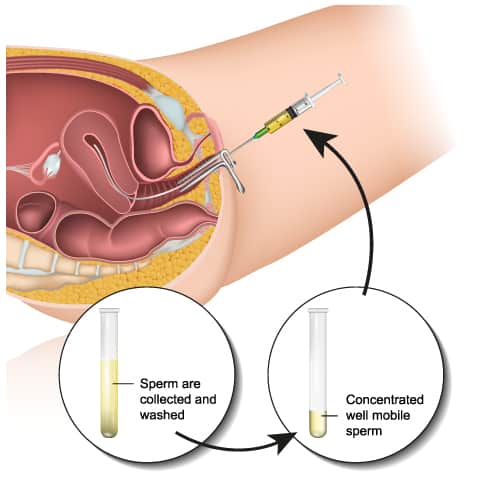 IUI Treatment - All You Need to Know About IUI Treatment