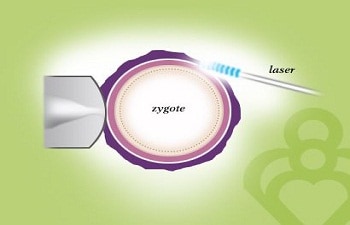 Procedure of Laser Assisted Hatching