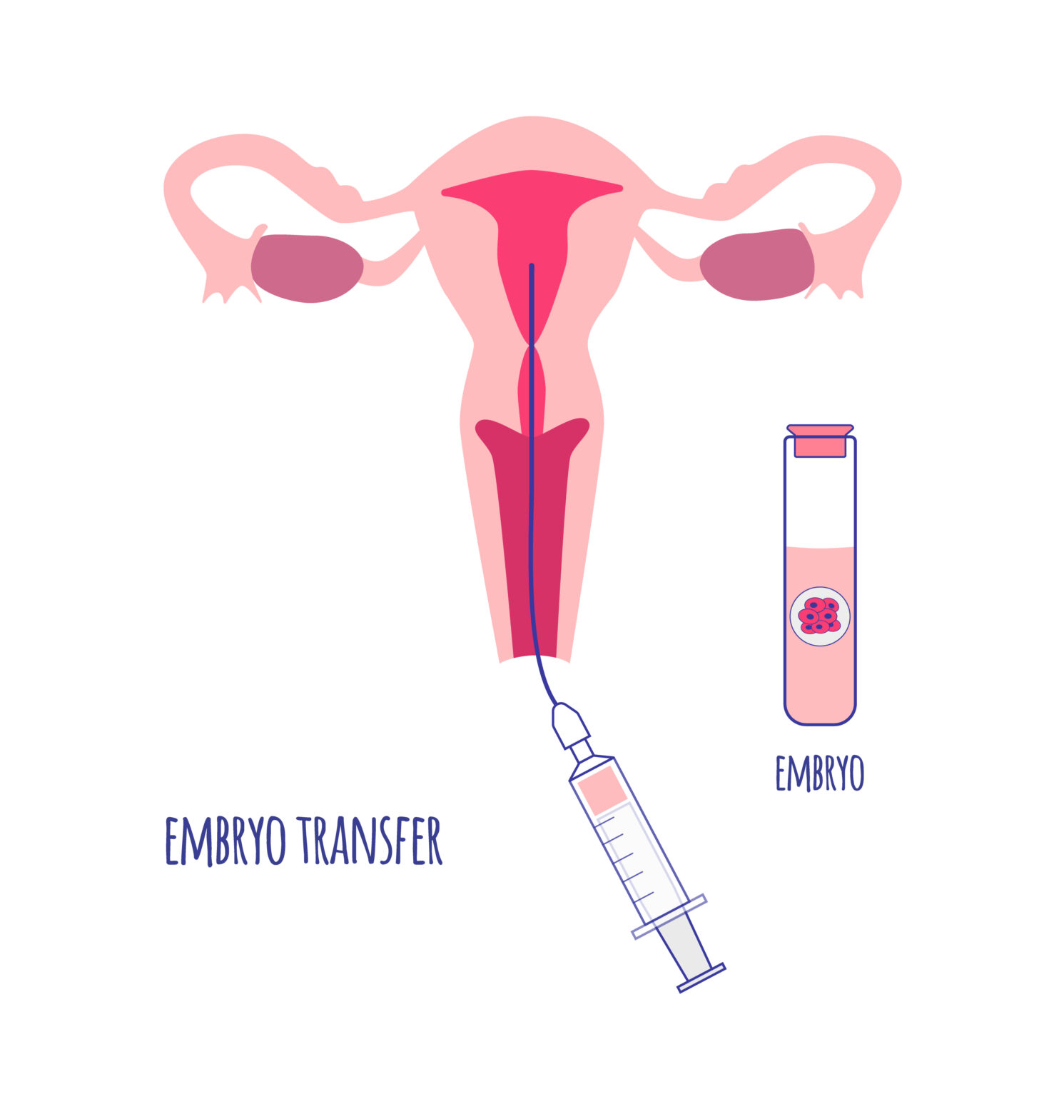 How to Prepare for Embryo Transfer?