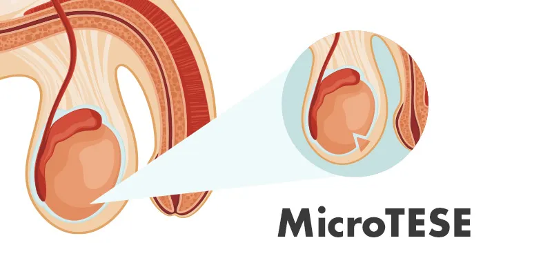 MicroTESE: A Microscopic Solution for Male Infertility