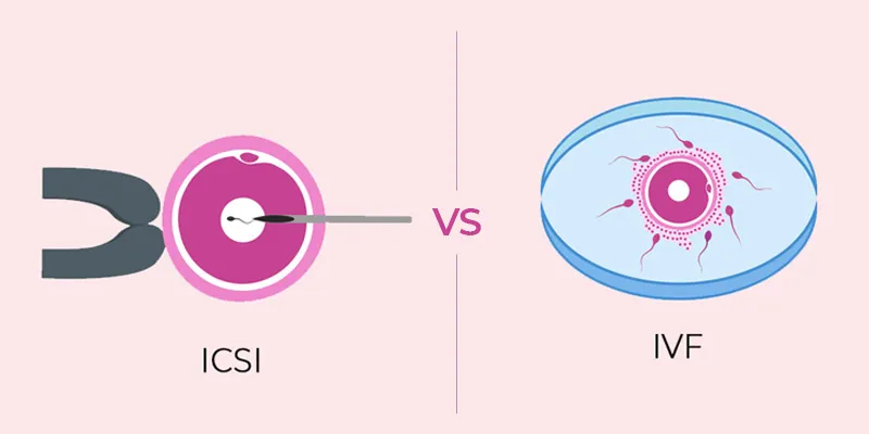 Comparing ICSI and IVF Procedure: Choosing the Right Fertility Treatment