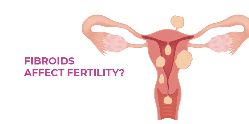 Navigating Infertility and Fibroids: A Comprehensive Guide