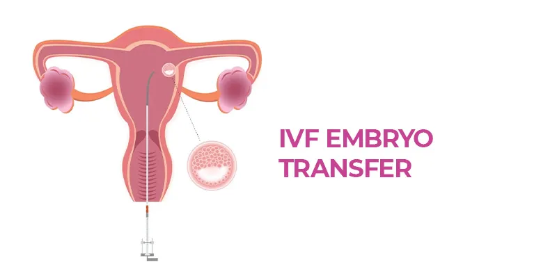 Navigating IVF Embryo Transfer: Everything You Need to Know