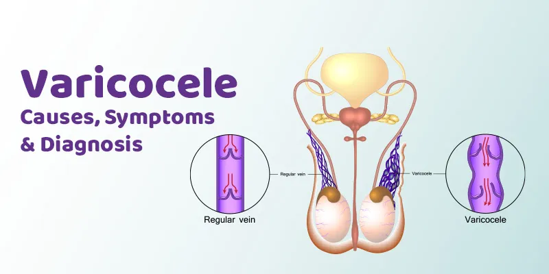 Varicocele - Causes, Symptoms & Diagnosis