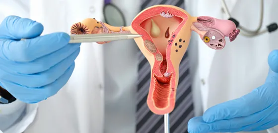 PCOS and Infertility