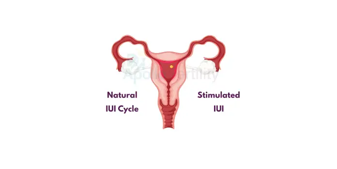 Natural IUI Cycle vs Stimulated IUI: Which Gives Better Results?